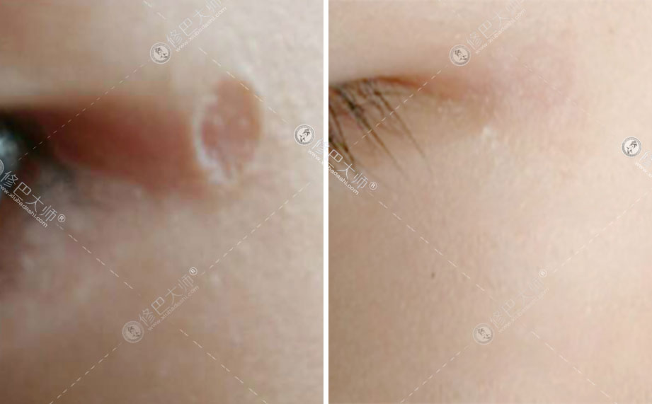 眼角凹陷疤痕修复